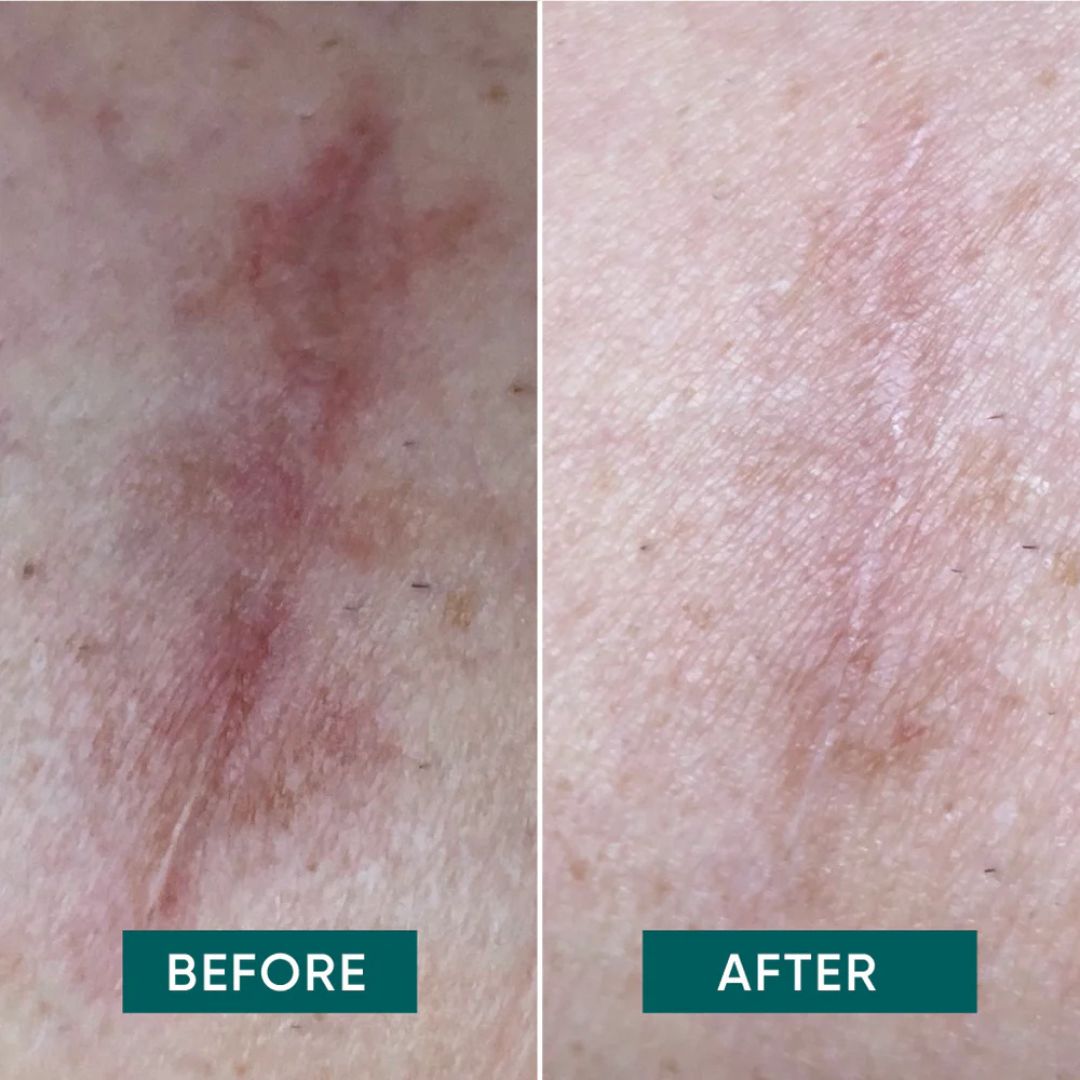 Narbenpads mit Aloe Vera